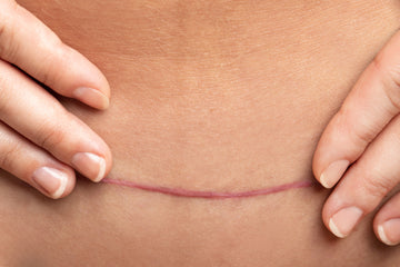 Healing in Harmony: A Guide to Scar Care After Pregnancy and C-Sections