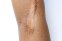 What Causes Atrophic Scars and Latest Treatment Options
