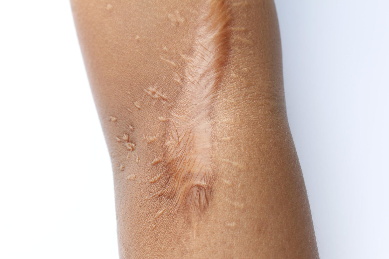 What Causes Atrophic Scars and Latest Treatment Options