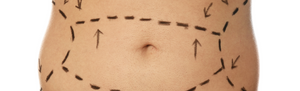 How Should You Feel Mentally After a Tummy Tuck: A Guide to Emotional Well-being