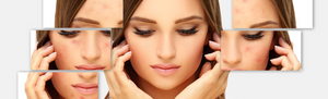 Navigating the Emotional Journey: Mental Health Effects of Acne Scars