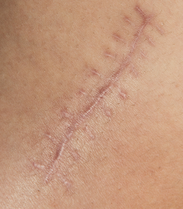 The Different Types of Scarring: Understanding and Treating Skin Scars