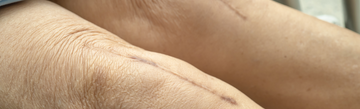 The Physical Impact of Old Scars: Understanding the Effects and Solutions
