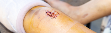 Effective Strategies on How to Physically Overcome a New Scar