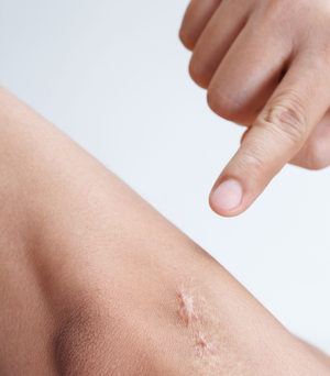 How to Care for a Scar: Comprehensive Guide for Optimal Healing