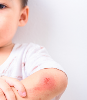 Scar Treatment for Kids: Comprehensive Guide for Effective Healing – Motivo  Scar Care