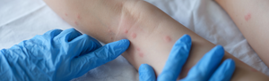 Dealing with Scars from Chicken Pox: Tips for Prevention and Treatment