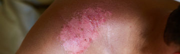 Bad Burns and the Scars They Leave: Understanding, Treating, and Coping