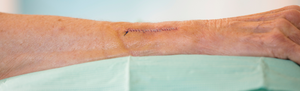 Different Types of Surgeries on Your Limbs and The Physical Impacts