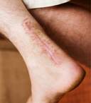 The Different Types of Scarring