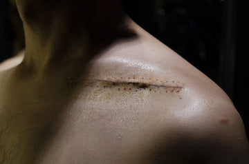 Optimizing Your Recovery: Effective Scar Care for Athletes