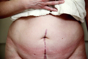 Caring for Your C-Section Scar: Tips for Proper Recovery