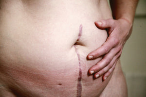 Mastering C-Section Scar Care: A Guide to Promote Healing and Boost Confidence