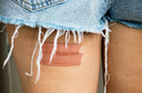 Signs Your Keloid Injury Needs Medical Attention