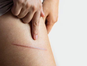 Optimal Performance, Optimal Healing: A Guide to Scar Care for Athletes