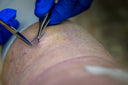 Keloid Scar removal