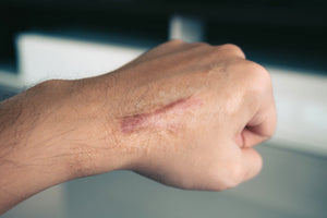 hand scar