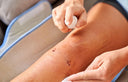 scar healing