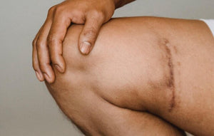 Scar Care and Management for Active Athletes: Boost Performance and Confidence